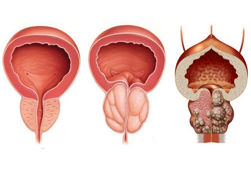 stadi della prostatite e necessità di trattamento con Prostavit